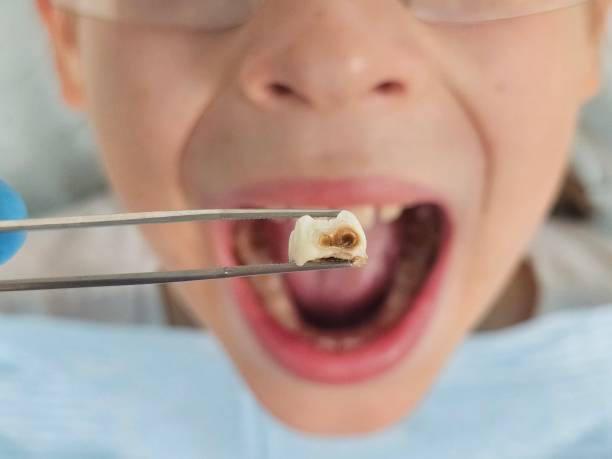 Best Dentist for Tooth Abscess  in Curwensville, PA